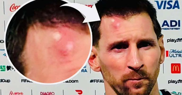 Messi sưng vêu trán sau trận thắng Cabo Verde: Vì sao nên nỗi? - hình ảnh - new88pg8.com Messi sưng vêu trán sau trận thắng Cabo Verde: Vì sao nên nỗi? - hình ảnh - new88pg8.com